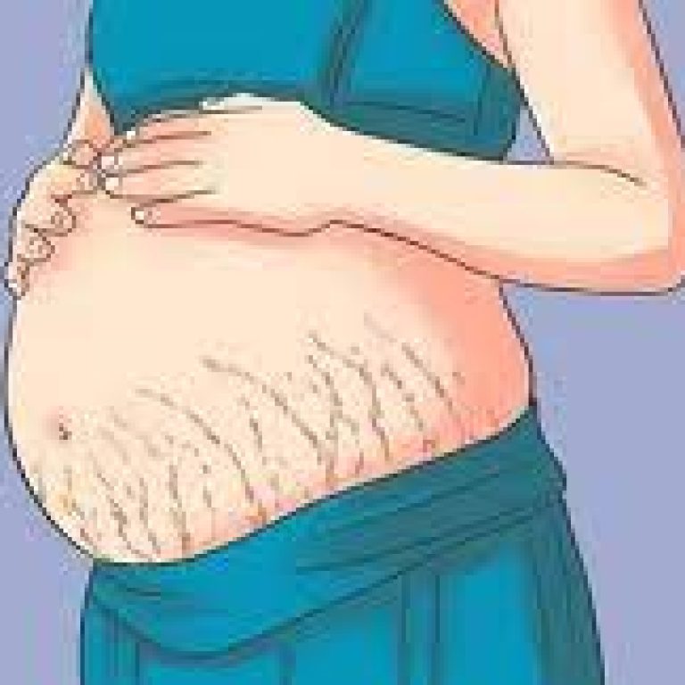 stretchmark